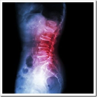 Back Pain Woodbury NJ Arthritis