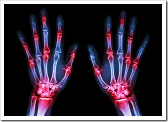 Rheumatoid Arthritis Solutions Woodbury NJ