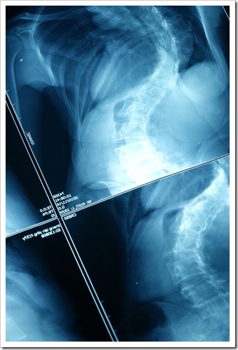 Gloucester County Scoliosis