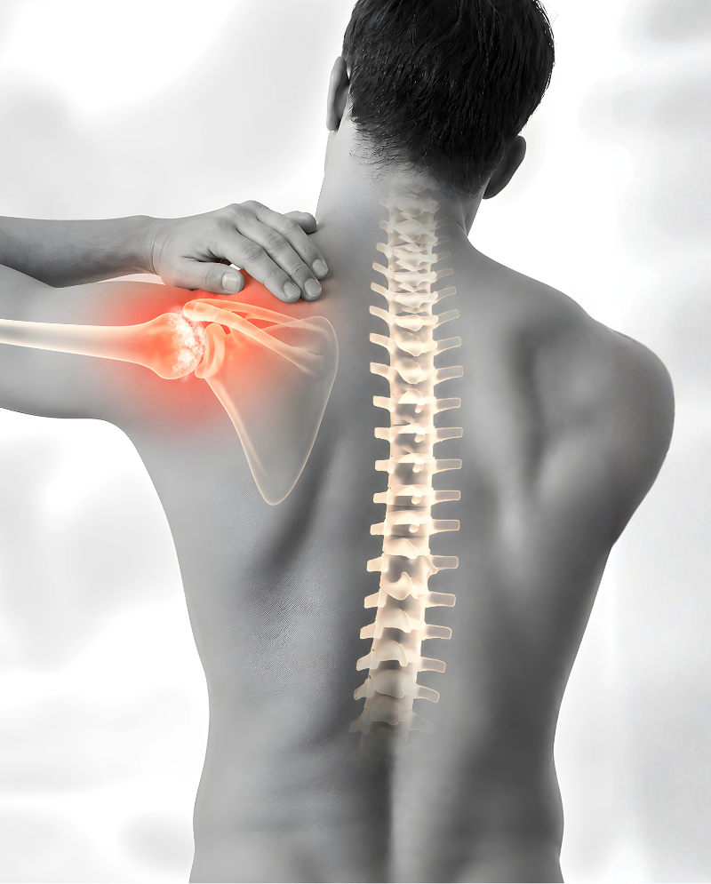 calcific-tendonitis